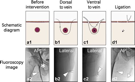 high saphenous vein ligation evaluation